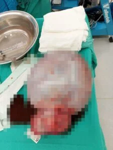 Antalya'da İngiliz hastanın karnından 6 kilogram kitle çıkarıldı